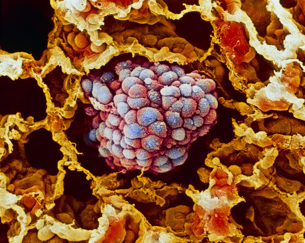 Lung cancer, close-up