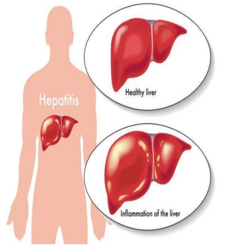 hepatiti-b-problem-shendetsor-global-3-638