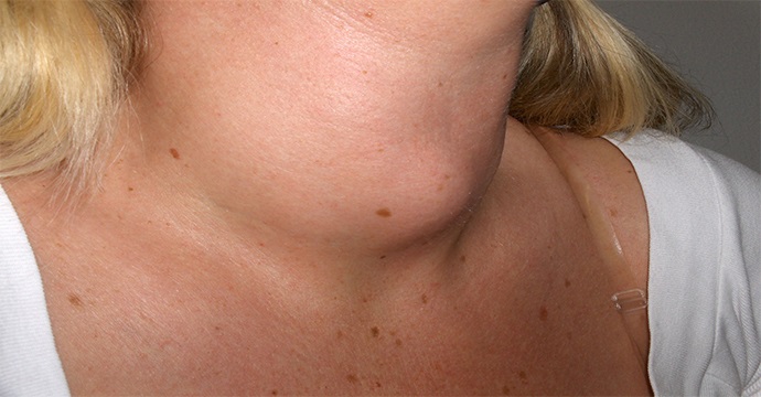 tiroide-gola-latticini