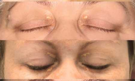 depozita kolesteroli syte