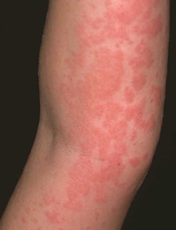 orticaria-2