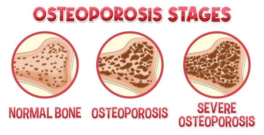 osteoporoza1