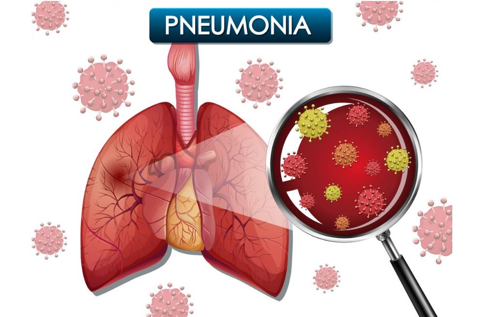 pneumonia